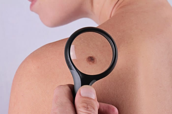 King’s College Hospital London - Abu Dhabi shares some top tips for checking your skin King’s College Hospital London - Abu Dhabi shares some top tips for checking your skin